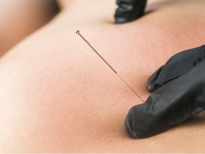 tecnica puncion seca galea