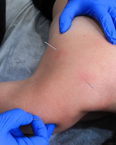 tecnicas invasivas galea