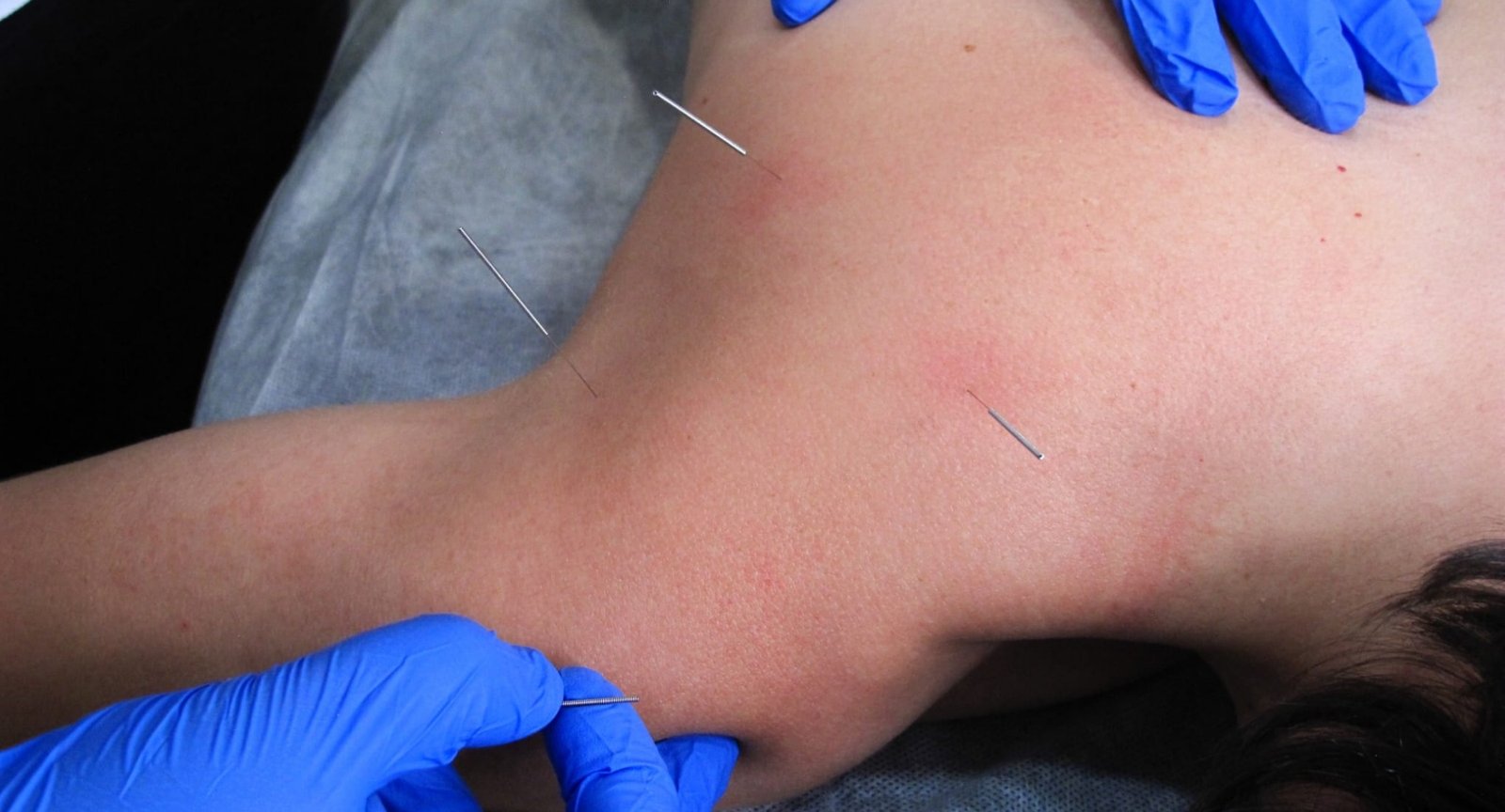 tecnicas invasivas 1 galea